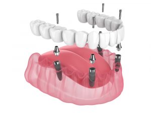 full dentures